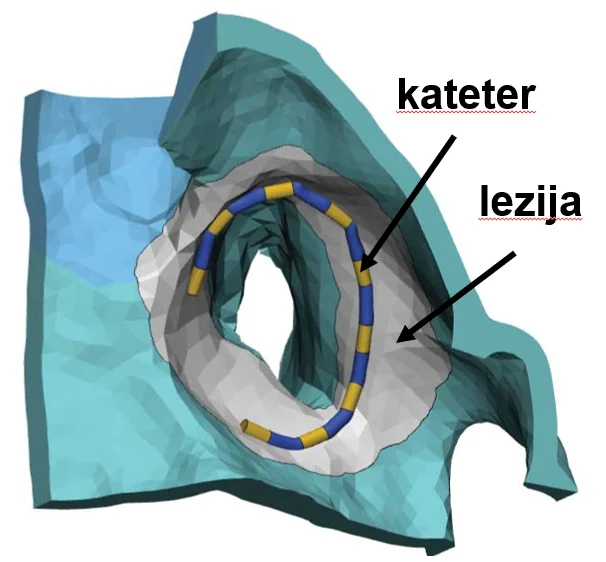The principle of PFA for treatment of atrial fibrillation