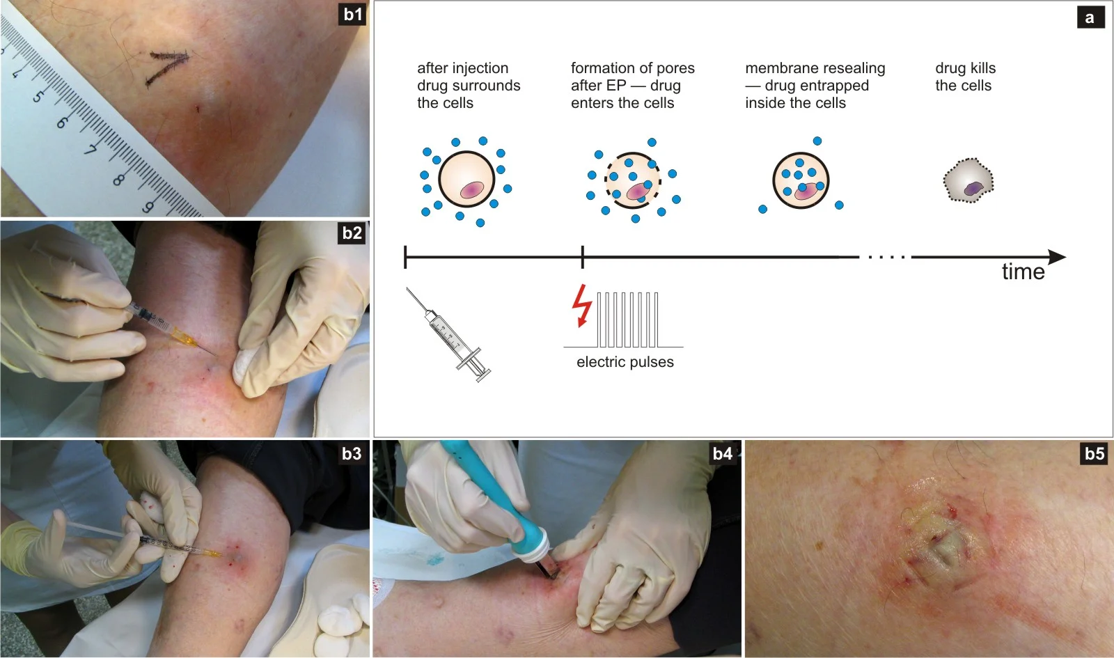 Principle of electrochemotherapy of tumors