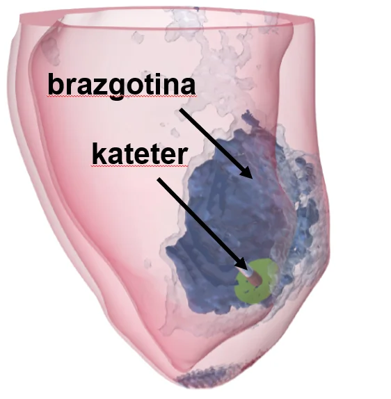 Application of numerical modeling to predict the area in the myocardium affected by PFA treatment