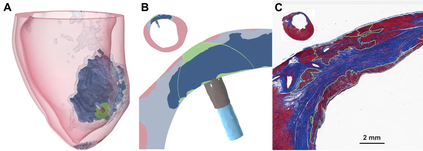 Patient-specific treatment planning workflow for percutaneous ECT